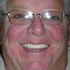 Older man with repaired and replaced top teeth
