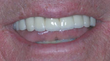 Replaced and repaired top teeth