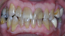 Severely discolored teeth closeup