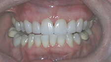 Closeup of smile after treatment