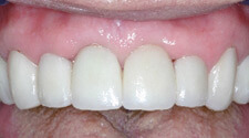 Closeup of healthy teeth and gums