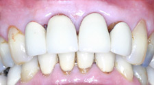 Closeup of unhealthy teeth and gums