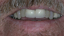 Man with irregular front teeth