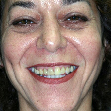 Woman with yellowed top teeth