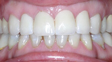 Closeup of brilliant white smile