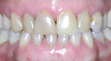 Closeup of yellowed top teeth