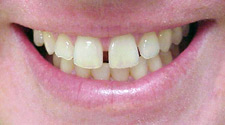 Gap between front teeth