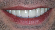 Closeup of brilliant white smile