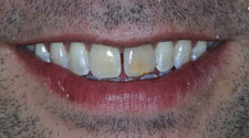 Closeup of discolored front teeth