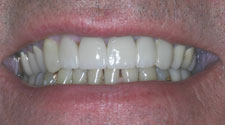 Healthy bright smile closeup