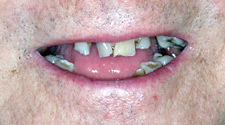 Severely decayed and damaged teeth